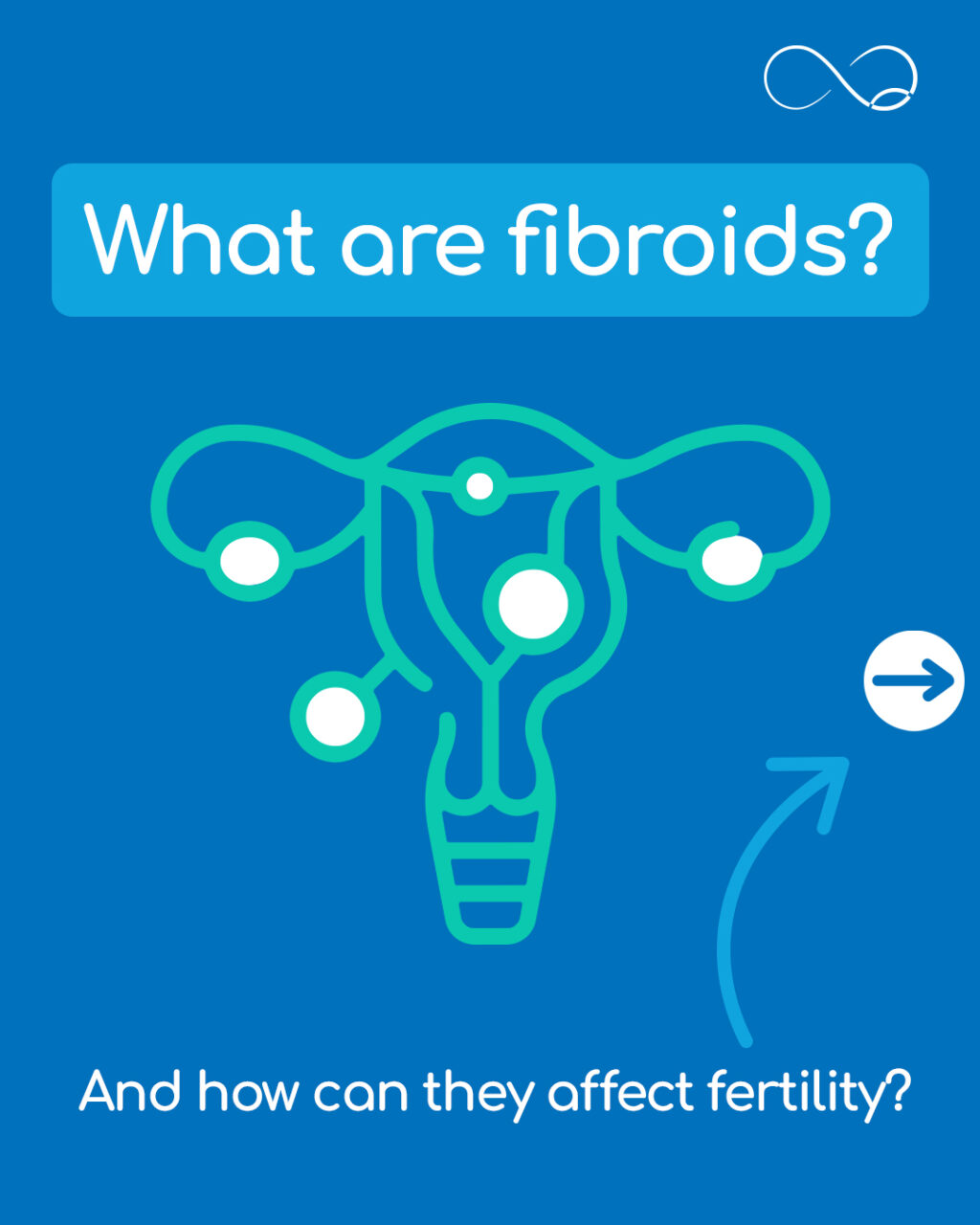 Fibroids are common, benign growths that can develop in the uterus. Many people have them without experiencing any symptoms, but in some cases, they can make it harder for an embryo to implant.

As part of your initial consultation, we’ll use an ultrasound scan to check for fibroids, alongside other factors that may be affecting your fertility.

If you’re seeking answers about your fertility, call or email our team to book a consultation. 

#fertility #fibroids
